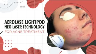 Aerolase LightPod Neo Laser Technology for Acne Treatment  Beverly Hills CA [upl. by Ganny318]