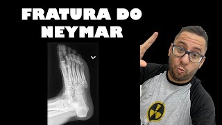 FRATURA DO NEYMAR FRATURA DE JONES [upl. by Eatnoid884]