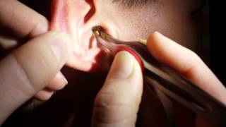 Removing impacted ear wax [upl. by Nelehyram]