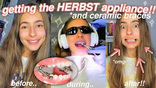 getting the HERBST APPLIANCE and BRACES full process [upl. by Sterling979]