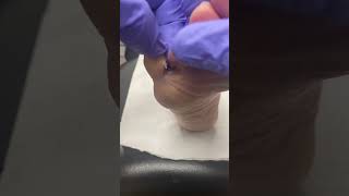 Unveiling smooth feet no more pinch callus Tune in to our Aussie podiatrist’s tips [upl. by Haney526]