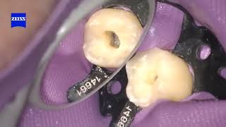 Mandibular First Molar Access Preparation [upl. by Bowden590]