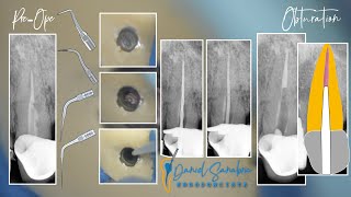 Ultrasonic U600 Woodpecker  Root canal retreatment OD 23  Fiber Post removal  Semorr microscope [upl. by Acinorrev24]