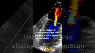 Meet the FibroScan [upl. by Erised]