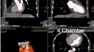 Coronary CT Angiography RCA Stenosis [upl. by Socem]