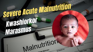 Severe Acute Malnutrition Kwashiorkor Marasmus Protein Energy Malnutrition Robbins Chapter 8 [upl. by Ramal38]