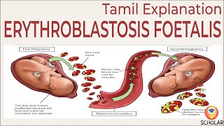 Understanding Erythroblastosis Fetalis Causes Symptoms and Treatments  Tamil Explanation [upl. by Leiso]