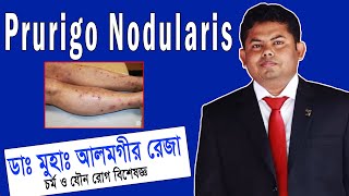 Prurigo Nodularis চিকিৎসা ও সঠিক ব্যবস্থাপনা  ডা আলমগীর রেজা  প্রুরিগো নোডুলারিস চিকিত্সা [upl. by Eisoj724]