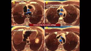 Matching anatomical relations in thoracic cross sections [upl. by Ainezey651]