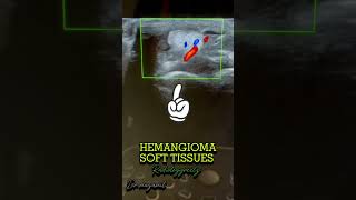 HEMANGIOMA soft tissues  radiologist fy radiological fypyoutube radiologiest viralshort [upl. by Asile61]