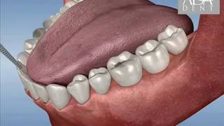 Endodonti Kanal Tedavisi [upl. by Aicire]