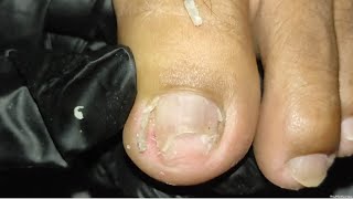 Vlog 1100Dry SkinIngrown Removal PEDICURE 1000 [upl. by Yrrok785]