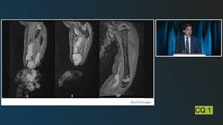 Improving Outcomes in NF1 pNF and Other Tumor Treatment [upl. by Attenyw]