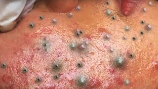 Big Cystic Acne Blackheads Extraction Blackheads amp Milia Whiteheads Removal Pimple Popping  5714 [upl. by Atenahs]