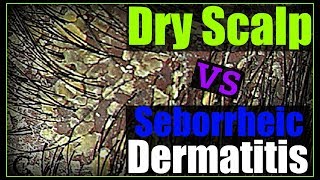 How to Get Rid of Dandruff Seborrheic Dermatitis amp Dry Scalp [upl. by Muraida497]