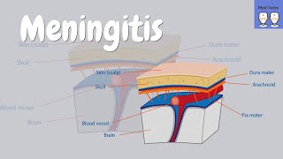 Meningitis bacterial vs viral symptoms Kernigs sign clinical clues meningococcal infection [upl. by Noorah]