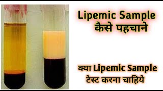 Lipemic blood sample  Lipemic  Lipemic serum [upl. by Asquith899]