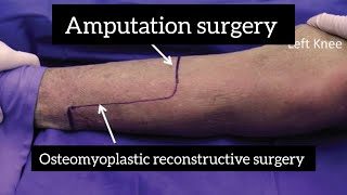 Amputation surgery part 2  osteomyoplastic reconstructive surgery [upl. by Lambertson912]