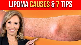 Lipoma Causes  7 Tips to Get Rid of Them  Dr Janine [upl. by Cosimo]