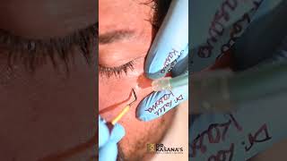 World’s best laser for mole Removal Treatment at Dr Kasana’s Clinic [upl. by Berneta388]