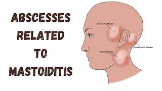 Abscesses related to mastoiditis  Complications of otitis media [upl. by Tyoh]