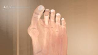 La correction de lhallux valgus et de ses complicationsDr Coillard  Dr Boublil  Dr Grisard [upl. by Meerek]