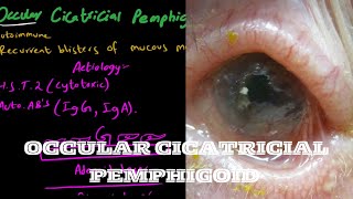 Ocular Cicatricial Pemphigoid  mucous membranous pemphigoid [upl. by Adalbert]