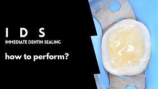 Immediate Dentin sealing  How to perform  Full protocol [upl. by Oicangi]