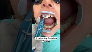 Step by step porcelain veneer makeover ❤️ [upl. by Singer]