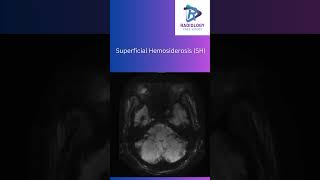 Superficial HemosiderosisSuperficialHemosiderosisNeuroRadiologyMRIImaging SusceptibilityMRI [upl. by Yreved]