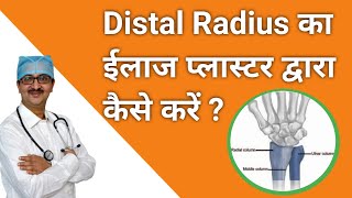 How to treat fracture distal radius by plaster and its result kneepain kneeexercise [upl. by Iralav]