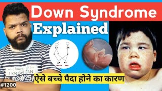 Down Syndrome Explain In Hindi  Causes Symptoms Treatment [upl. by Milano489]