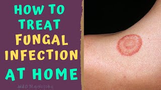 HOW TO TREAT SKIN FUNGAL INFECTION INFECTION AT HOME TINEA RINGWORM REMEDIES HOW TO CURE [upl. by Nawak]