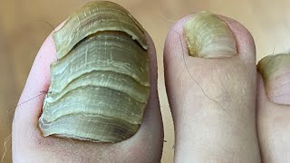 Así tratamos un dedo con HONGOS de hasta 5 UÑAS nails foot viral pedicure [upl. by Nyliret]