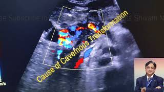 Portal Cavernoma on ultrasound Liver causes amp findings portal vein cavernous transformation [upl. by Airlee]