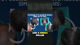 Dermaroller for hair loss  before amp after PHOTOS [upl. by Acirema]