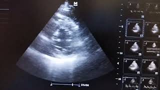 Global hypokinesia of left ventricle improved after Rx in PSAX echo view at mid ventricular level [upl. by Ayouqes]