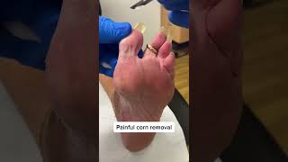 Experience the relief of proper corn removal by Aussie Podiatrist FootCare PainFree🦶👣💪 [upl. by Rosinski]