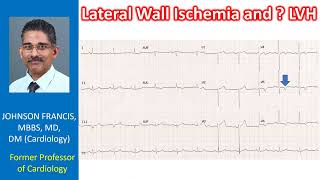 Lateral Wall Ischemia and LVH [upl. by Lowrance]