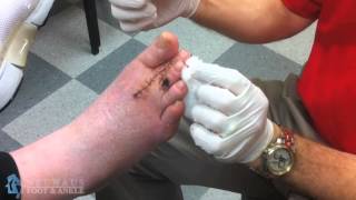 Dr Matthew Neuhaus Removes Wire From Toe After Hammertoe Surgery [upl. by Atil]