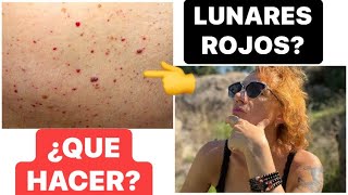 ¿TIENES LUNARES ROJOS EN EL CUERPO PREVENCIÓN Y SANACION [upl. by Ciryl]