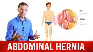 What Causes An Abdominal Hernia – DrBerg on Hernia Causes [upl. by Erica]