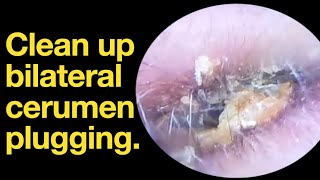 Clean up bilateral cerumen plugging ear wax removal  ear cleaning  ASMR  relaxation  relax [upl. by Shrier]