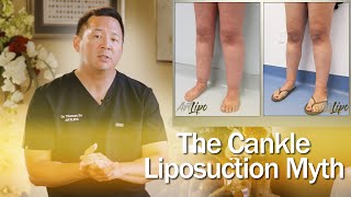 Lipedema Surgery  Cankle Liposuction  Expert Dr Thomas Su  ArtLipo [upl. by Ode882]