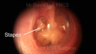 Retraction pocket right eardrum  type 3 [upl. by Elbert]