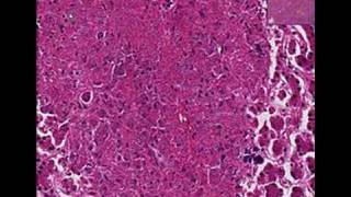 Histopathology Liver Histoplasmosis [upl. by Schecter]