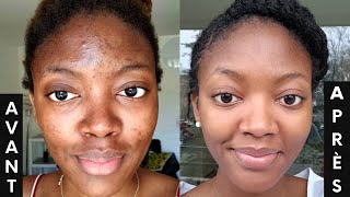 L ACNÉ COMMENT s en DÉBARRASSER 3 PRODUITS contre les boutons et les tâches🔥  SKINCARE ROUTINE💦 [upl. by Hsetim]