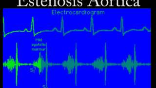 Soplo de la Estenosis Aórtica [upl. by Sewellyn586]