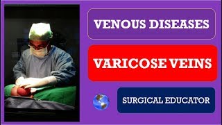 VARICOSE VEINS How To DIAGNOSE amp TREAT Venous Diseases [upl. by Luhar]