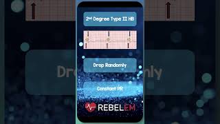 2nd Degree Type II Heart Block REBELEM ECG EKG HeartBlocks [upl. by Ifen584]